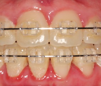 Sabit Ortodontik Aygıtların Bakımı