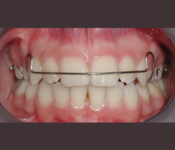 Hareketli Ortodontik Aygıtların Bakımı