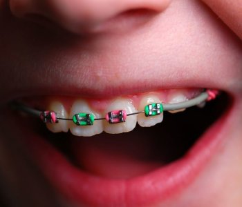 Ortodontik Tedavilerde Dikkat Edilmesi Gerekenler